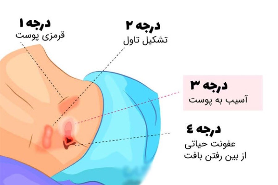 زخم بستر چیست؟ روش جلوگیری و بهترین روش های درمان آن